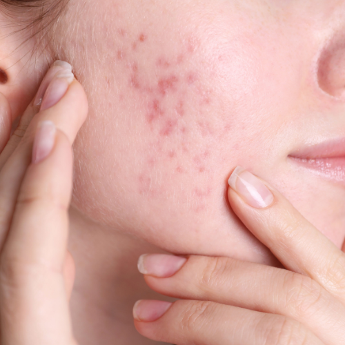 Acne, melasma, dermatites